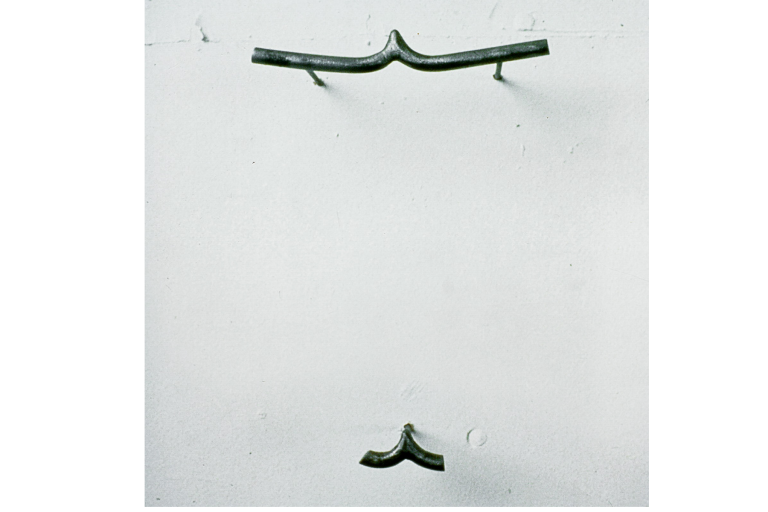Liposuction Buttocks, 1989